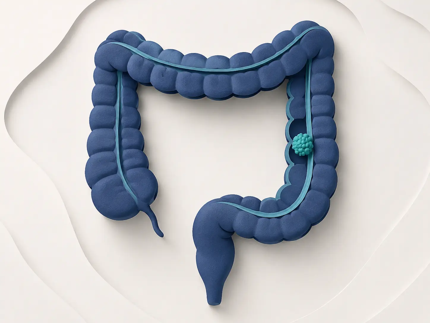 Ilustração médica sobre Câncer de cólon