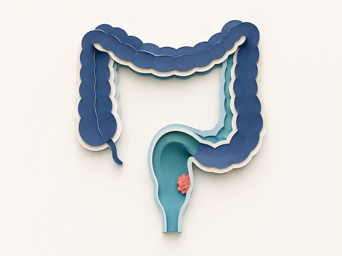 Ilustração médica sobre Câncer de reto